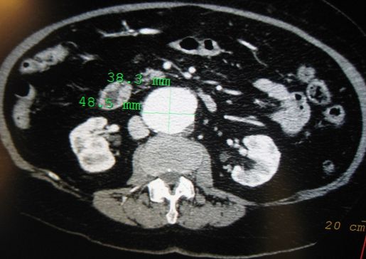 abdominal aortic aneurysm